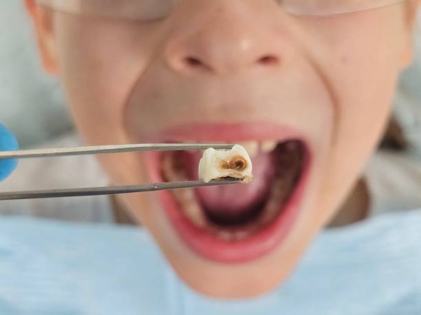 Best Emergency Tooth Extraction in Lemon Hill, CA
