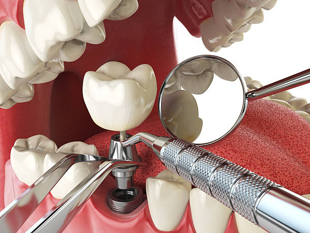 Best Emergency Tooth Extraction in Lemon Hill, CA